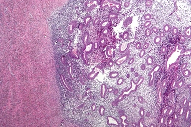 A micrograph showing endometriosis (right) and ovarian stroma (left).