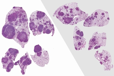 MIT researchers found that lung tumors in mice treated with antibiotics (right, purple stain) were much smaller than untreated lung tumors (left).
