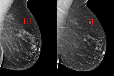 The team's model was shown to be able to identify a woman at high risk of breast cancer four years (left) before it developed (right).