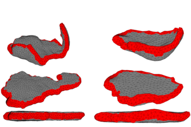 An algorithm developed at MIT takes MRI images of placentas (top) and flattens them to be more easily analyzed (middle and bottom).