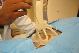 Robopsy, a new invention designed to help doctors do needle biopsies, is shown as it might be positioned for surgery. Robopsy was invented by a team of graduate students, including two from MIT.