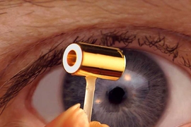 A tiny chamber made of gold, called a hohlraum, is used to contain the pellet of heavy hydrogen fuel at the center of a fusion reaction at the National Ignition Facility. Laser beams enter through the two open ends of the hohlraum and are reflected in toward the fuel, heating it up to produce the fusion reaction.