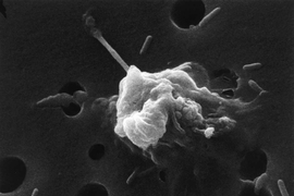 An image of a cancer cell undergoing apoptosis (cell death).