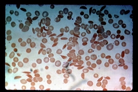 Researchers from MIT, Harvard, MGH and Brigham and Women's Hospital have developed a microfluidic device that can analyze the behavior of blood samples from sickle cell disease patients, which usually include many crescent-shaped cells.