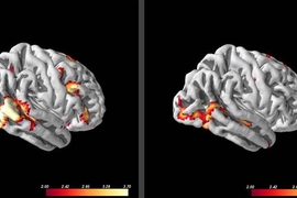 Social anxiety patients with more activity in visual processing areas, left, when viewing images of angry faces, responded better to subsequent cognitive behavioral therapy than patients with lower activity in those regions.