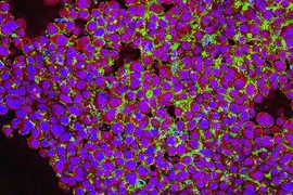 Human breast cancer cells (purple) are targeted by nanoparticles (green) developed by MIT professor Paula Hammond. The particles bind to receptors overexpressed by cancer cells.