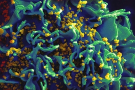 This scanning electron micrograph shows HIV particles infecting a human T cell.