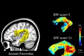 On the left, the arcuate fasciculus is highlighted in the brain. On the right, the colors of the arcuate fasciculus indicate the level of randomness of water diffusion within the structure, which reflects the integrity of white matter tracts and fiber organization. Higher fractional anisotropy (FA) scores indicate higher tract integrity. The MIT team found that those values correlated with scores ...