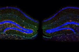 Blockade of p25 generation in the brain of an Alzheimer's disease mouse model mitigates amyloid plaque buildup. Hippocampal slices from a seven-month-old 5XFAD mouse (left) or 5XFAD;p35KI mouse (right), alongside markers for Aβ (red) and activated astrocyte (green). Nuclei are shown in blue.