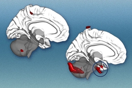 By analyzing brain regions, researchers can predict clinical responses to cognitive behavioral therapy in patients with social anxiety. 