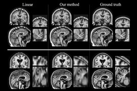 Researchers at MIT and other institutions have devised a way to boost the quality of low-resolution patient MRI scans so they can be used for large-scale studies. Images produced by their algorithm, shown in the center column, are much closer to high-resolution scans shown in the right column. In the left column are images produced by a different technique for improving low-resolution scans.
