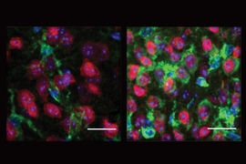 MIT neuroscientists have linked the vulnerability of neurons in Hungtington's disease to the release of mitochondrial RNA and an associated immune system response. In this image, on the right are neurons from a Huntington's model mouse showing much more PKR (a marker of immune response to mitochondrial RNA) in green than neurons on the left, which are from a healthy mouse. 