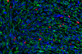 Microscope image of hundreds of tumor shows cells stained in blue, green, and red, on a black background