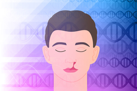 Illustration of person with cleft lip, and DNA in background.