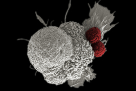 Cancer cell being attacked by two T cells.