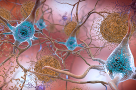 Neurons affected by plaques and forming tangles