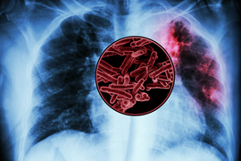 Tuberculosis infected lungs with a close up of tuberculosis bacteria