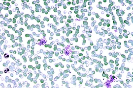 Red blood cells from a patient infected with Plasmodium falciparum.