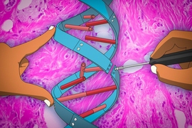 A new gene therapy technique being developed by researchers at MIT uses microRNAs — small noncoding RNA molecules that regulate gene expression — to control breast cancer metastasis.
