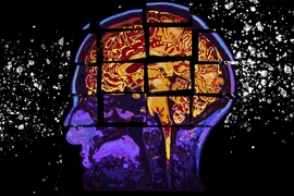 A model developed at MIT predicts the cognitive decline of patients at risk for Alzheimer’s disease by forecasting their cognition test scores up to two years in the future, which could help zero in on the right patients to select for clinical trials.
