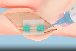 Rendering showing adhesive being applied to a flesh wound