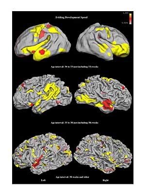 Larger-scale folds develop the fastest in premature (born more than seven weeks early) infants (top), while medium-scale folds develop the fastest in older premature infants, born between seven and two weeks early (middle). In older infants and children, fine folds develop the most quickly across the brain surface (bottom).