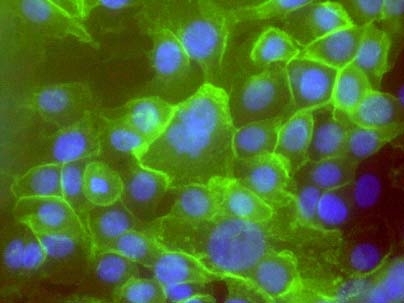Pathologist Tan Ince transformed the normal cells into these cancerous ones (whose membranes are stained green). The transformed cells retain their sheet-forming capabilities, resembling the tumor cells found in many patients. They also possess enormous potential to create and spread tumors. As many as one in ten is a cancer stem cell.