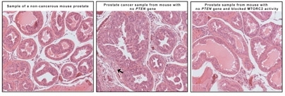 The image on the left shows a sample from a normal prostate, with organized cells lining the O-shaped ductules. Â Mice without theÂ PTENÂ gene had developed cancer, which is characterized by enlarged glands and disorganized cells clogging the ductules (middle image). Â When mTORC2 activity is blocked in mice lacking the PTENÂ gene, the prostate ductulesÂ resemble the appearance of norm...