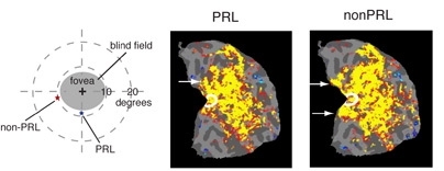 Left: A macular degeneration patient suffers vision loss in the central visual field of the retina (fovea) and uses a new fixation (PRL, preferred retinal locus) in the lower periphery for tasks such as reading. Visual stimuli were presented at the PRL and another peripheral location (nonPRL).

Middle and Right (fMRI scans): Central vision cortex (white circle) responds to both stimuli presented a...