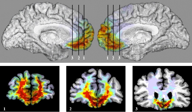 These brain scans show the locations of VMPC lesions in the nine patients who took part in this study.