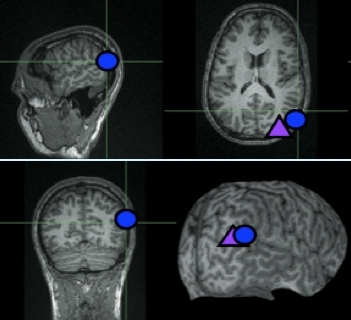 MRI brain scans showing the location of the right temporoparietal junction (blue circle). The purple triangle shows a nearby region that the researchers disrupted with magnetic stimulation as a control experiment. 