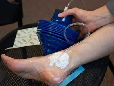 The simple pump creates negative pressure — shown here sealing a bandage on a leg wound — which speeds up the healing process.