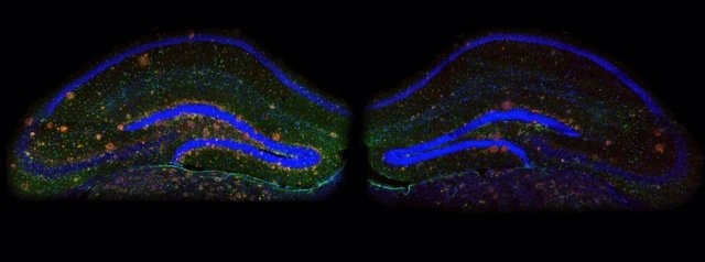 Blockade of p25 generation in the brain of an Alzheimer's disease mouse model mitigates amyloid plaque buildup. Hippocampal slices from a seven-month-old 5XFAD mouse (left) or 5XFAD;p35KI mouse (right), alongside markers for Aβ (red) and activated astrocyte (green). Nuclei are shown in blue.
