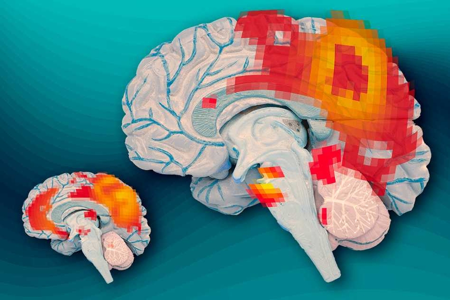 At left, the brains of adults who had ADHD as children but no longer have it show synchronous activity between the posterior cingulate cortex (the larger red region) and the medial prefrontal cortex (smaller red region). At right, the brains of adults who continue to experience ADHD do not show this synchronous activity.
