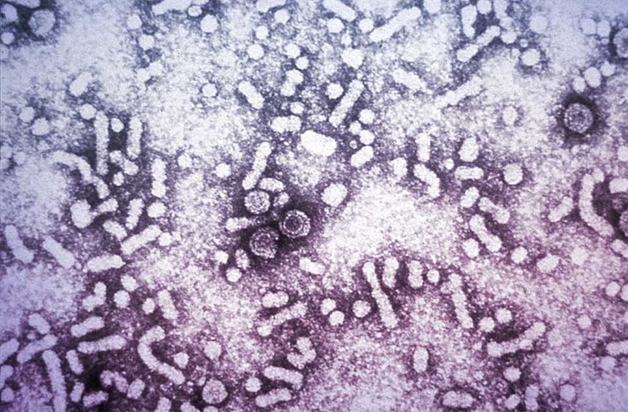 An electron micrograph shows the presence of hepatitis-B virus.
