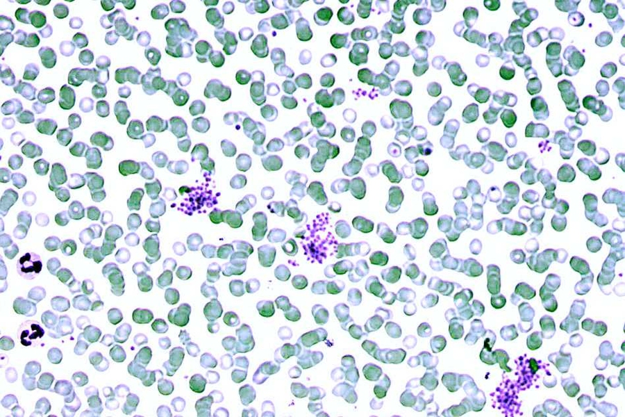 Red blood cells from a patient infected with Plasmodium falciparum.