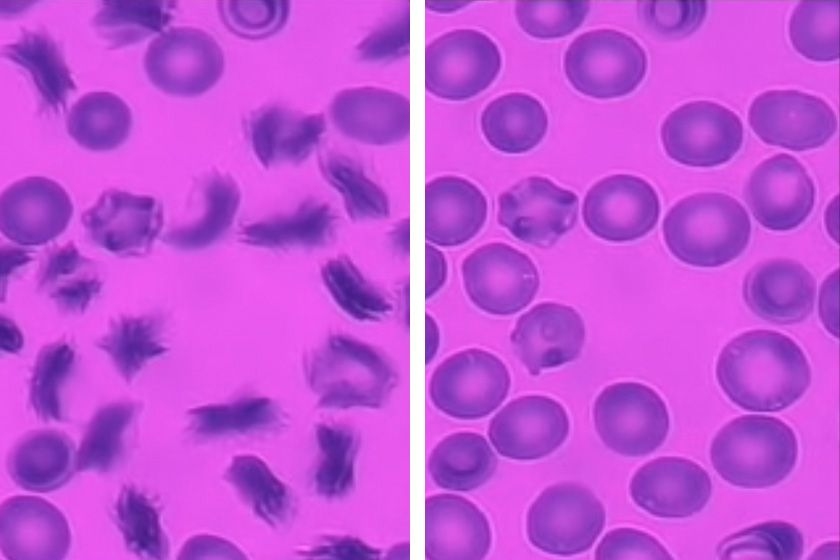 As red blood cells from sickle cell patients flow through the new MIT microfluidic device, many of them become sickled following exposure to a low-oxygen environment (left). At right, when oxygen levels are restored, the cells resume their normal shape.