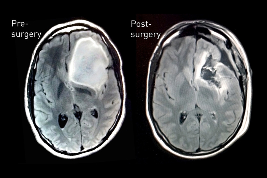 MRI data showing Keating’s astrocytoma tumor before and after surgical removal.