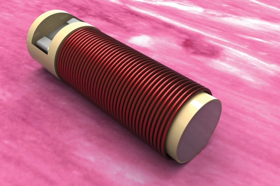 Illustration of the tiny biochemical sensor that can be implanted in cancerous tissue during an initial biopsy.