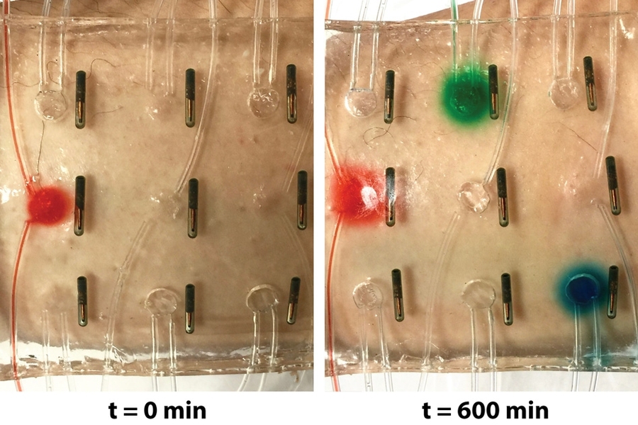 A stretchable, smart, hydrogel wound dressing includes temperature sensors and drug-delivery channels and reservoirs, embedded in a robust hydrogel matrix. Mock drugs can be released at various locations on demand, based on the measured temperatures.