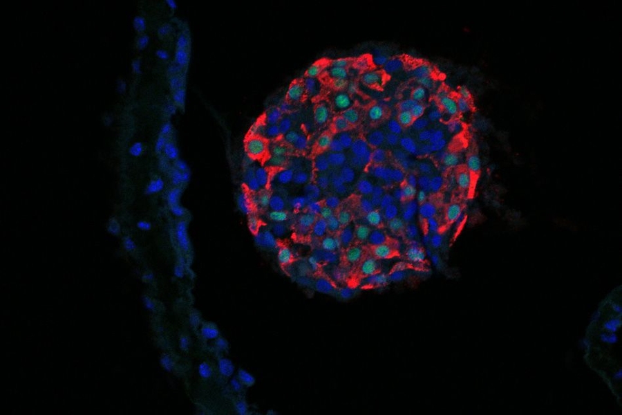 Glucose-stimulated insulin-producing cells, derived from stem cells, are protected inside capsules that are engineered to be invisible to the host immune system.
