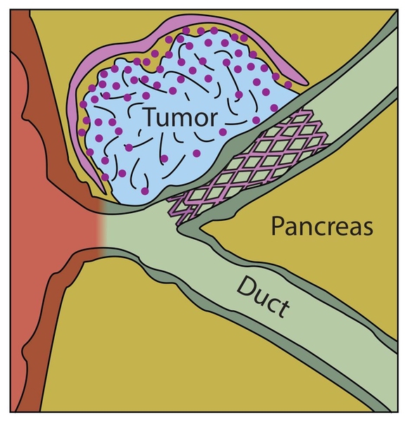 MIT researchers have designed a drug-delivering material that could be used to coat stents, helping the bile duct to remain clear in patients with pancreatic cancer.