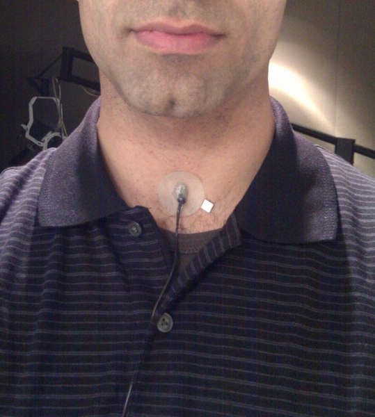 Accelerometers were worn around patients' necks to capture vocal fold data.