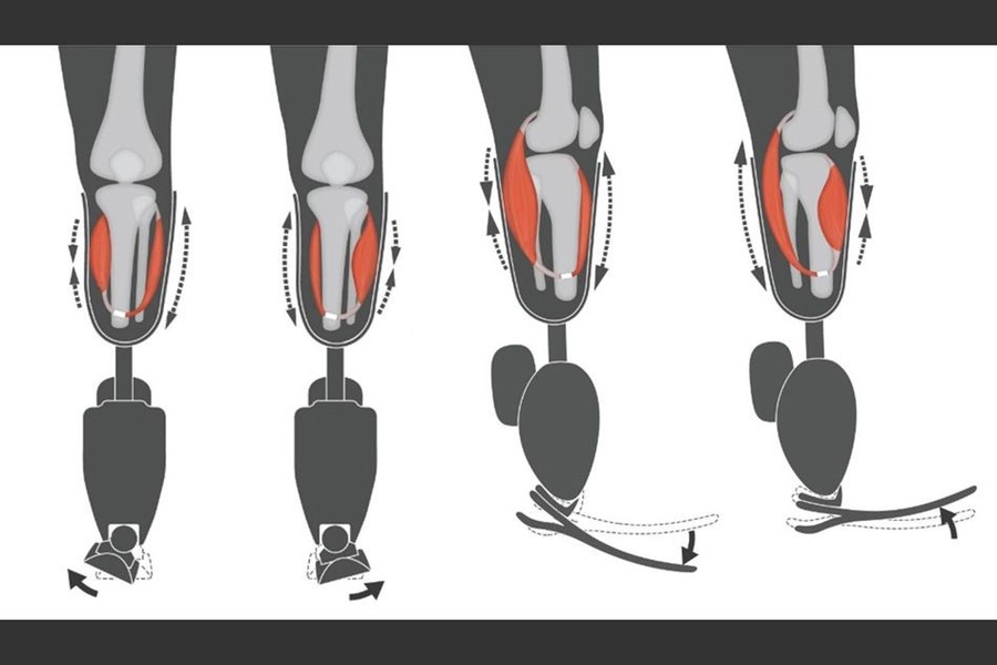 Two agonist-antagonist myoneural interface devices (AMIs) were surgically created in the patient’s residual limb: One was electrically linked to the robotic ankle joint, and the other to the robotic subtalar joint. 