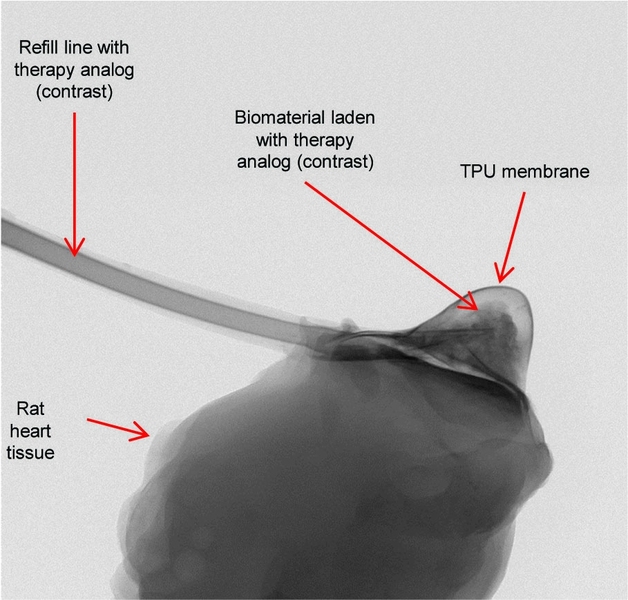 An image from a CT scanner shows the Therepi reservoir on an explanted heart.