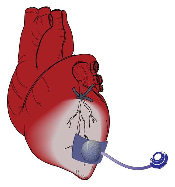 A schematic of the device attached to a heart