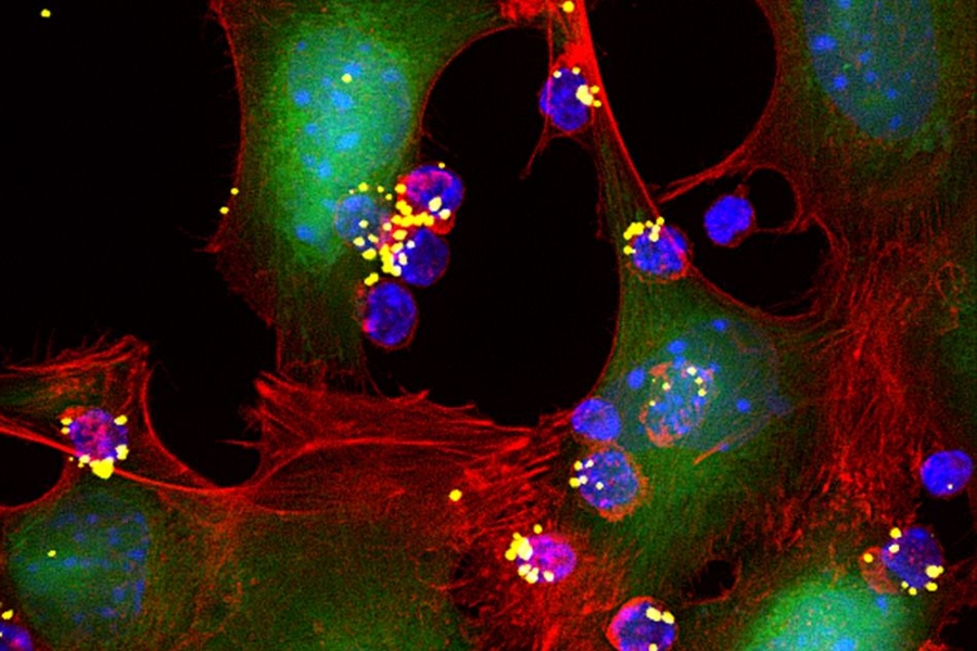 MIT engineers have designed nanoparticles that can be attached to T cells and release T-cell-stimulating molecules called cytokines (yellow spheres).  These cytokines activate T cells (blue) to attack nearby tumor cells.