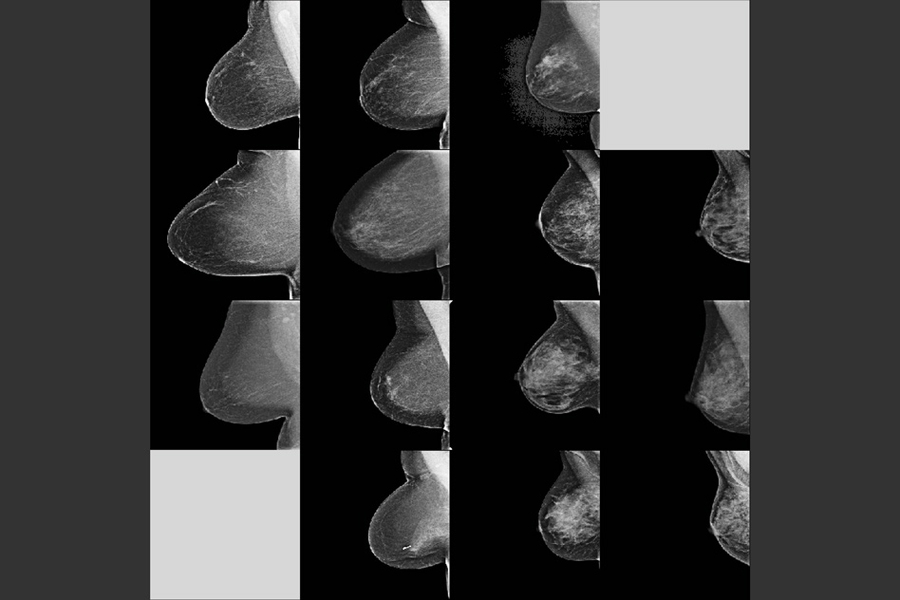In training and testing, the model learns to map mammogram features with correct density ratings from human experts in four categories — fatty, scattered, heterogeneous, and dense. It achieved a 94 percent agreement among Massachusetts General Hospital radiologists over 10,000 mammograms. In this image, the model’s density predictions are in the four columns, left to right; the radiologists’...