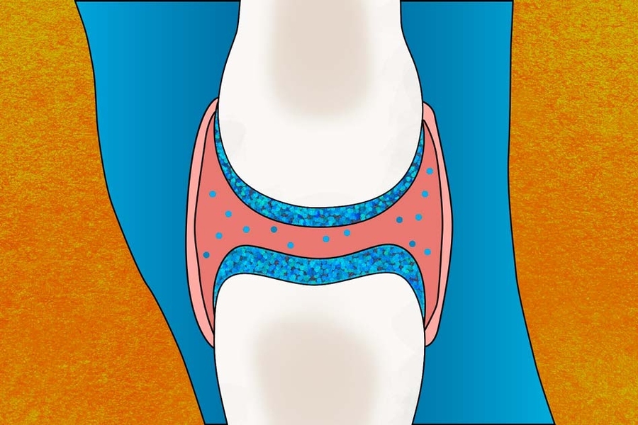 An illustration of the cartilage in a knee joint.