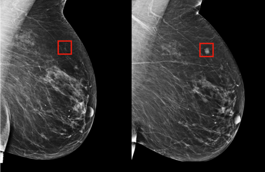 The team's model was shown to be able to identify a woman at high risk of breast cancer four years (left) before it developed (right).